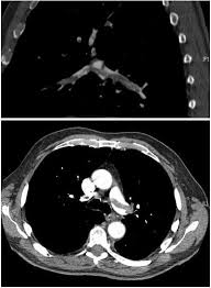 embolism