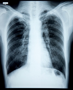 Cancerul pulmonar: cel mai mortal tip de cancer din lume | soferulamator.ro