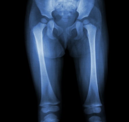 durere în articulația genunchiului picioarelor la copii)