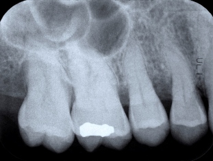 abces dentar