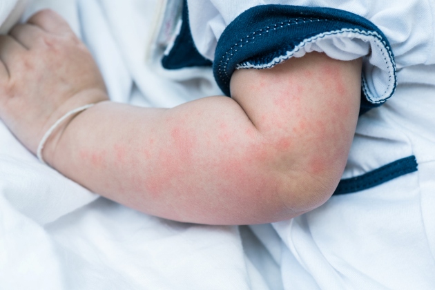 alergiile de vara la bebelus