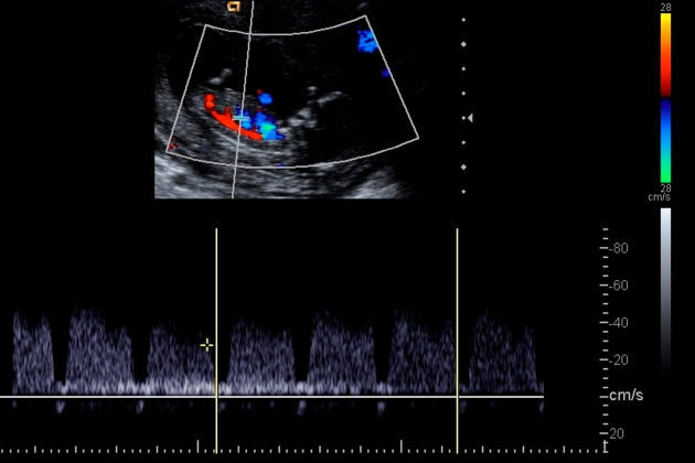 decesul intrauterin