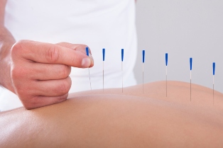 acupunctura