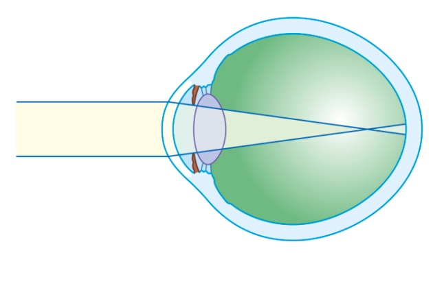 viziunea plutește în ochi miopia este minus 1 5