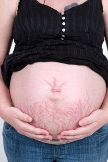 femeie gravida cu vergeturi