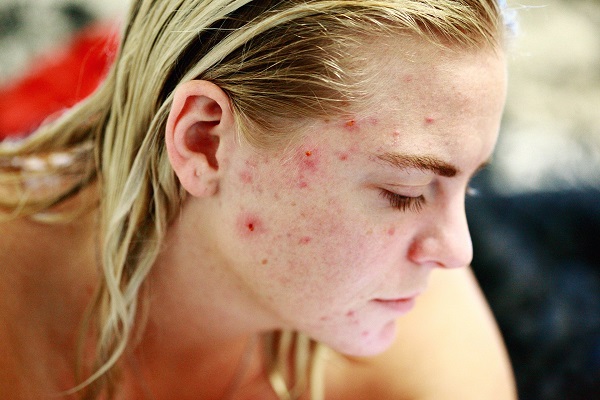 Femeie ce se confrunta cu acnee