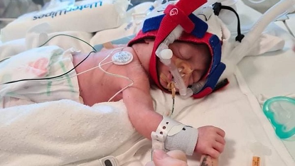 bebelus-nascut-prematur-si-cu-Sindrom-Crouzon-stand-la-terapie-intensiva