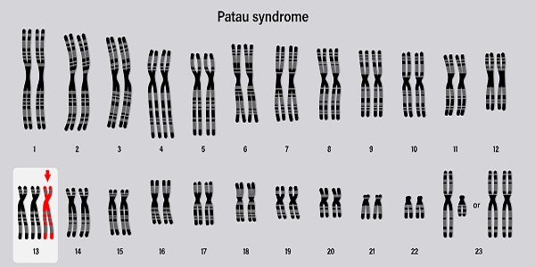 reprezentare-grafica-a-cariotipului-in-caz-de-sindrom-Patau