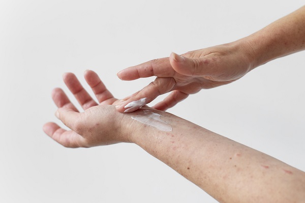 femeie care incearca sa aplice un unguent pe mâna afectată de o iritatie sau de o alergie