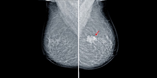 mamografie care arata microcalcifiere la san