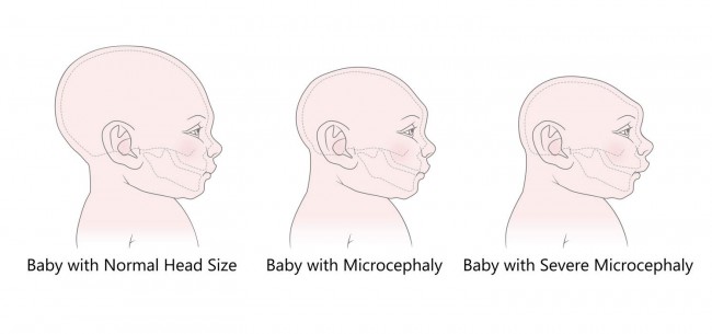 ilustratie microcefalie