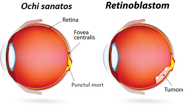 retinoblastom