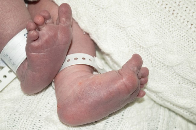 nou-nascut cu picior tal valg