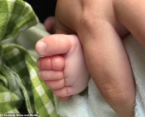 degetele de la picioare ale unui bebelus, cu fire de par rasucite in jurul lor