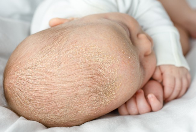 bebelus cu dermatita seboreica