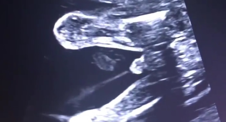 imagine de la ecografie 4D cu un bebelus care face pipi in uterul mamei