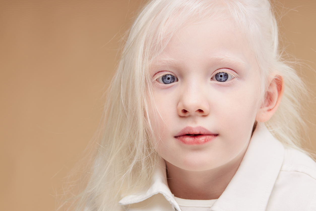 fetita cu albinism