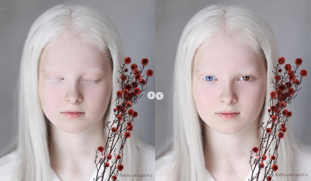 fetita cu albinism si ochi diferiti in culoare