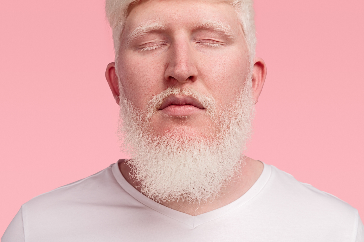 barbat cu albinism