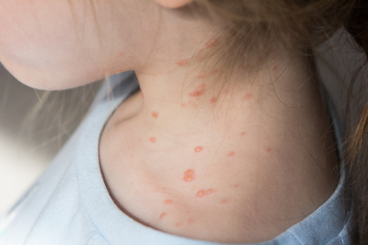 eruptie  de variola pe pielea unui copil