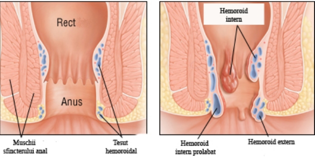 Totul Despre Hemoroizi