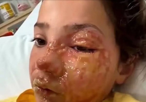 copila cu arsuri la nivelul feței