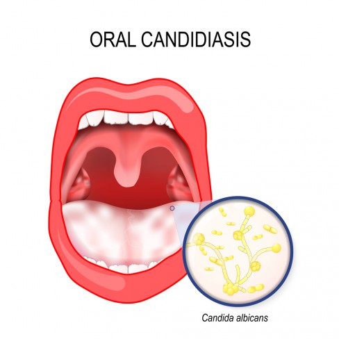 ilustratie-despre-candidoza-bucala-cu-o-gura-larg-deschisa-si-cu-desen-cu-bacteria-candida-albicans