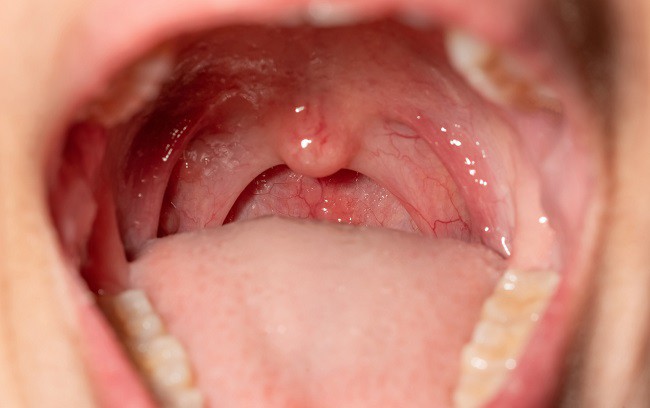 amigdalita-la-copii-imagine-din-interiorul-gurii
