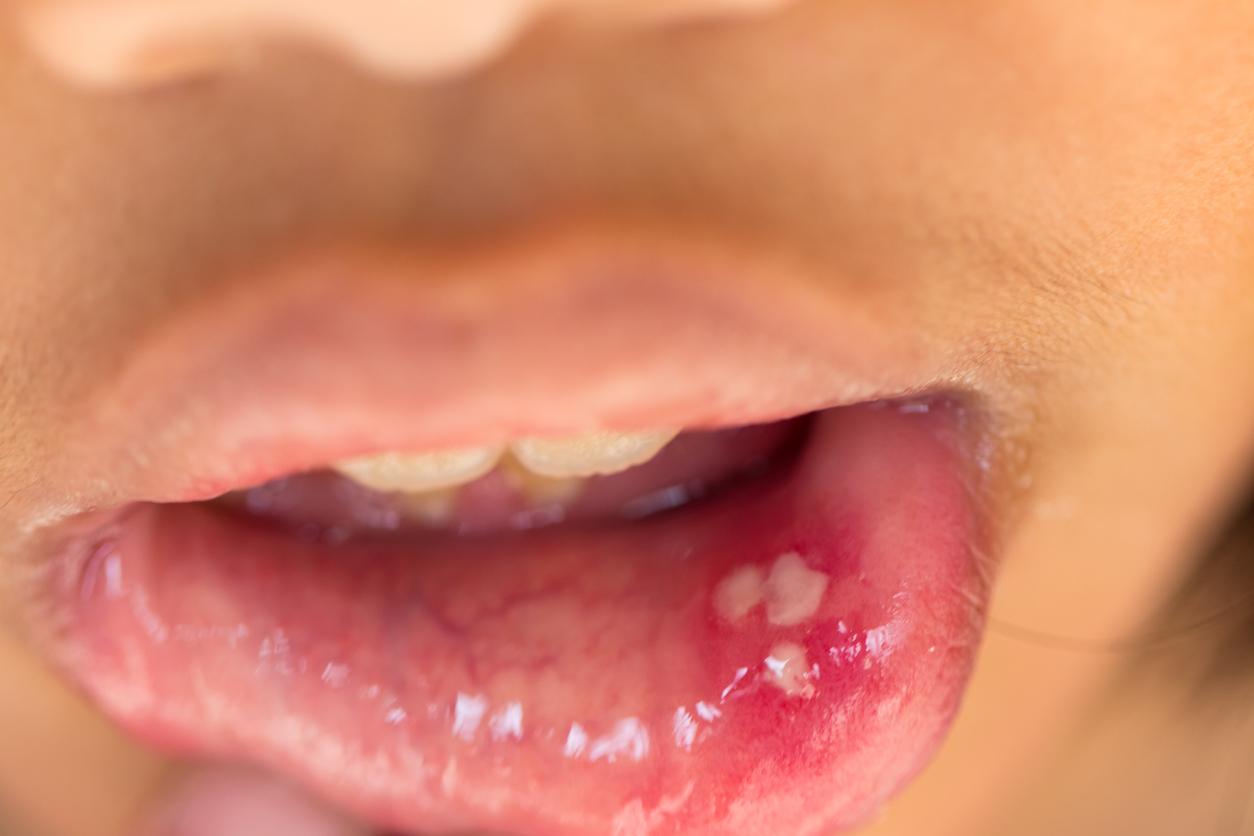 boala Behcet-copil cu afte bucale