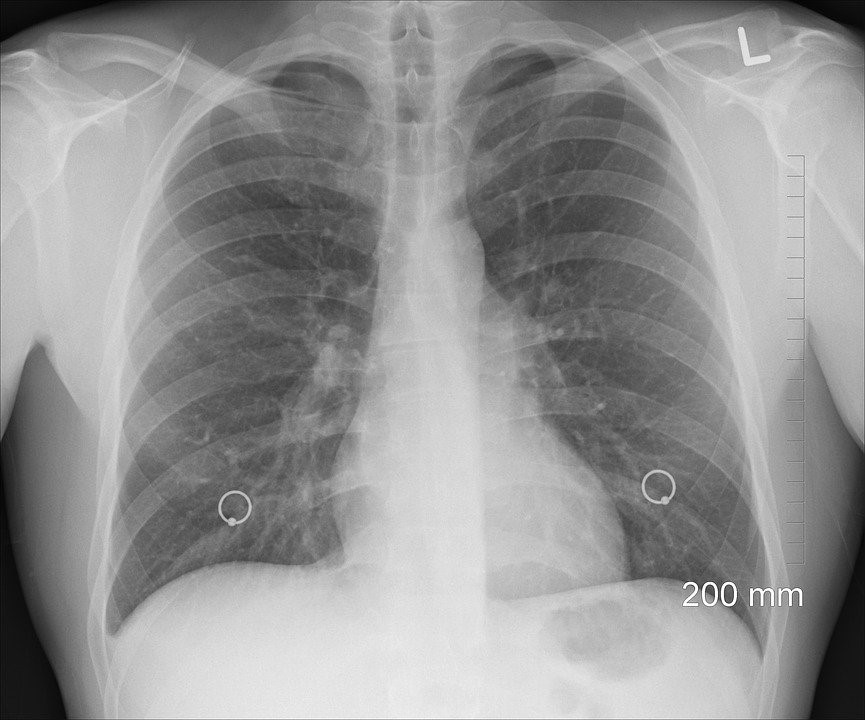 apa la plămâni-radiografie plămâni