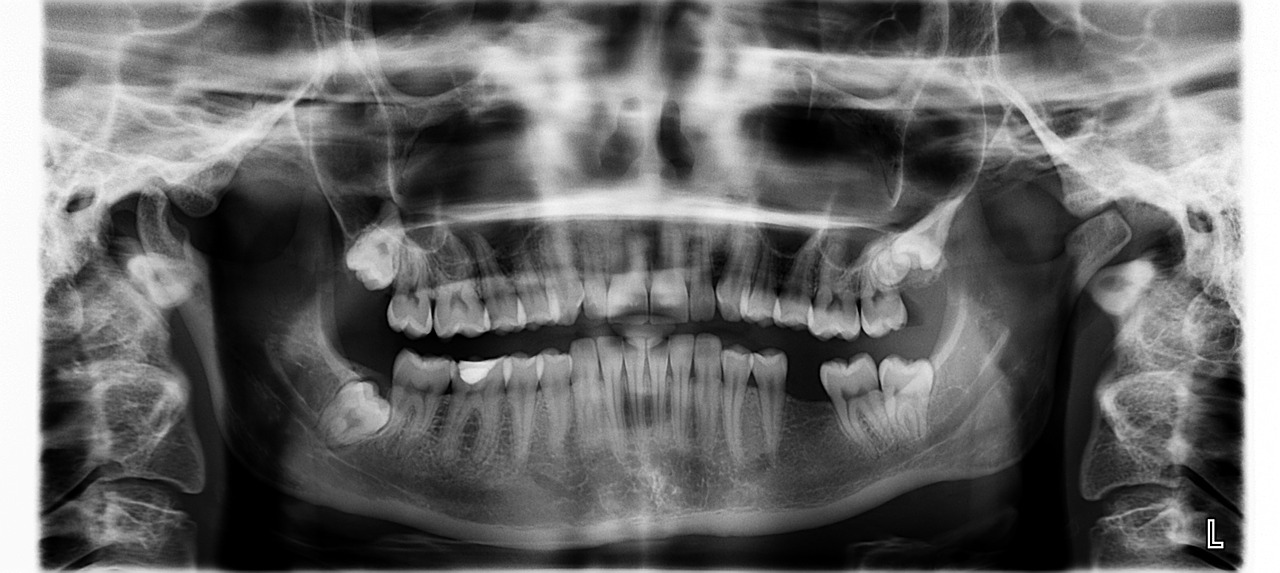 măseaua de minte la copii-radiografie dinți