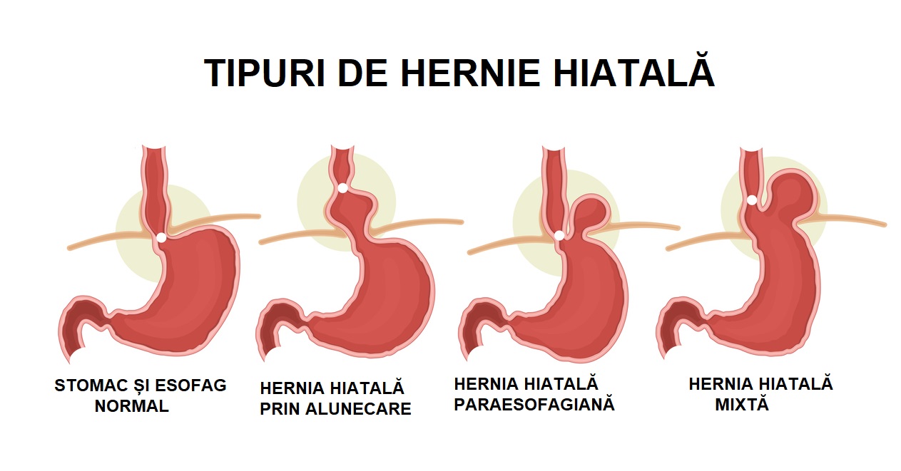 Hernia hiatala - simptome, cauze diagnostic tratament - BeHealthy