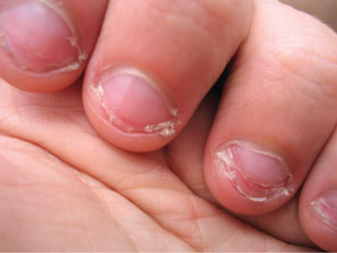 De ce se exfoliaza pielea din jurul unghiilor la copii