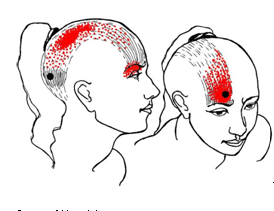 Nevralgia de nerv occipital mare sau nevralgia Arnold