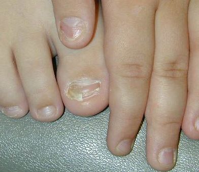 unghiile de la picioare cad ciuperci