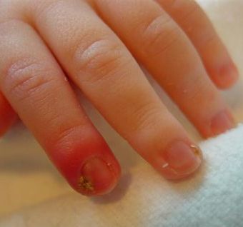 Cum să scapi de ciuperca unghiilor - Dermatită - 